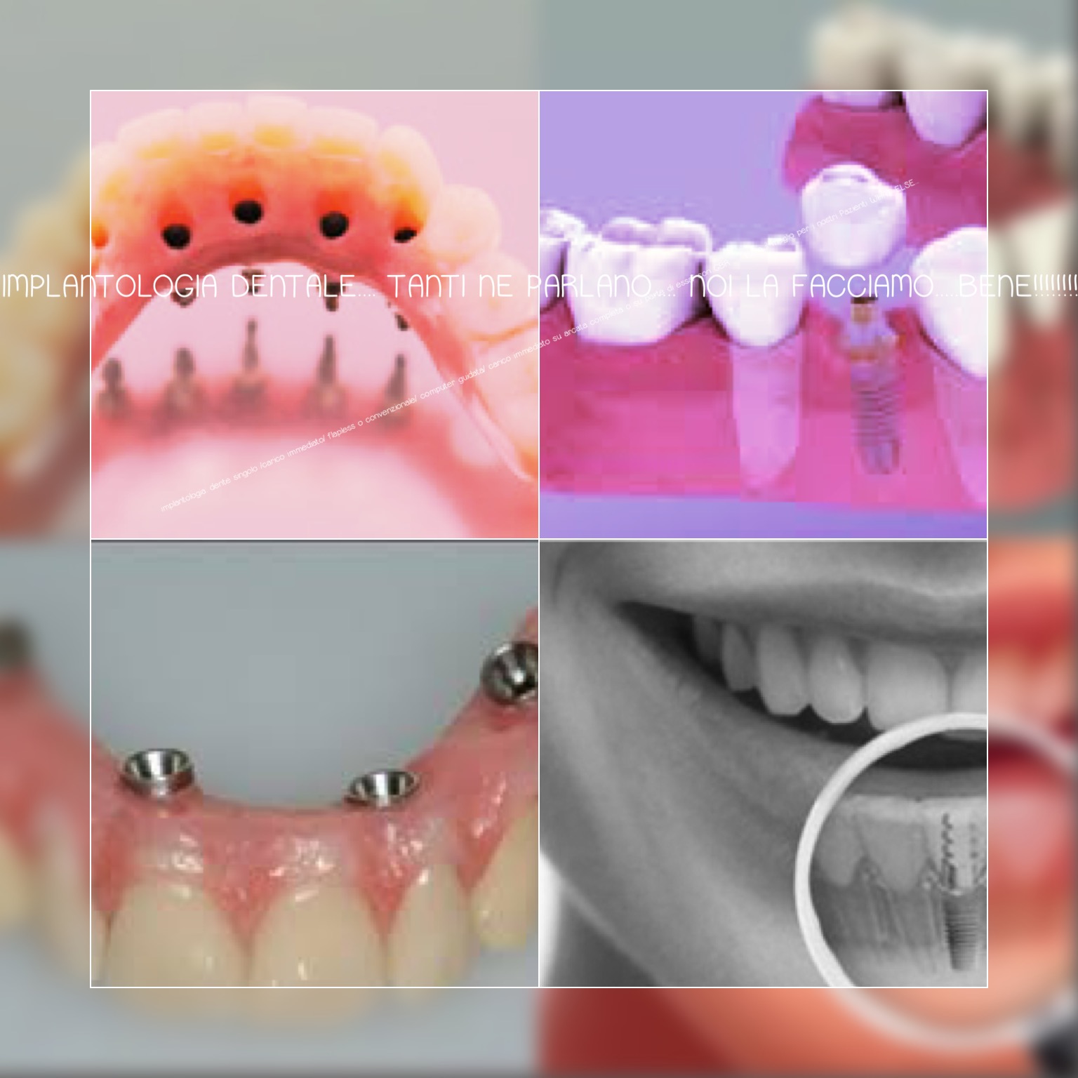 Studio Dentistico Laura Leo - Terapie - IMPLANTOLOGIA
