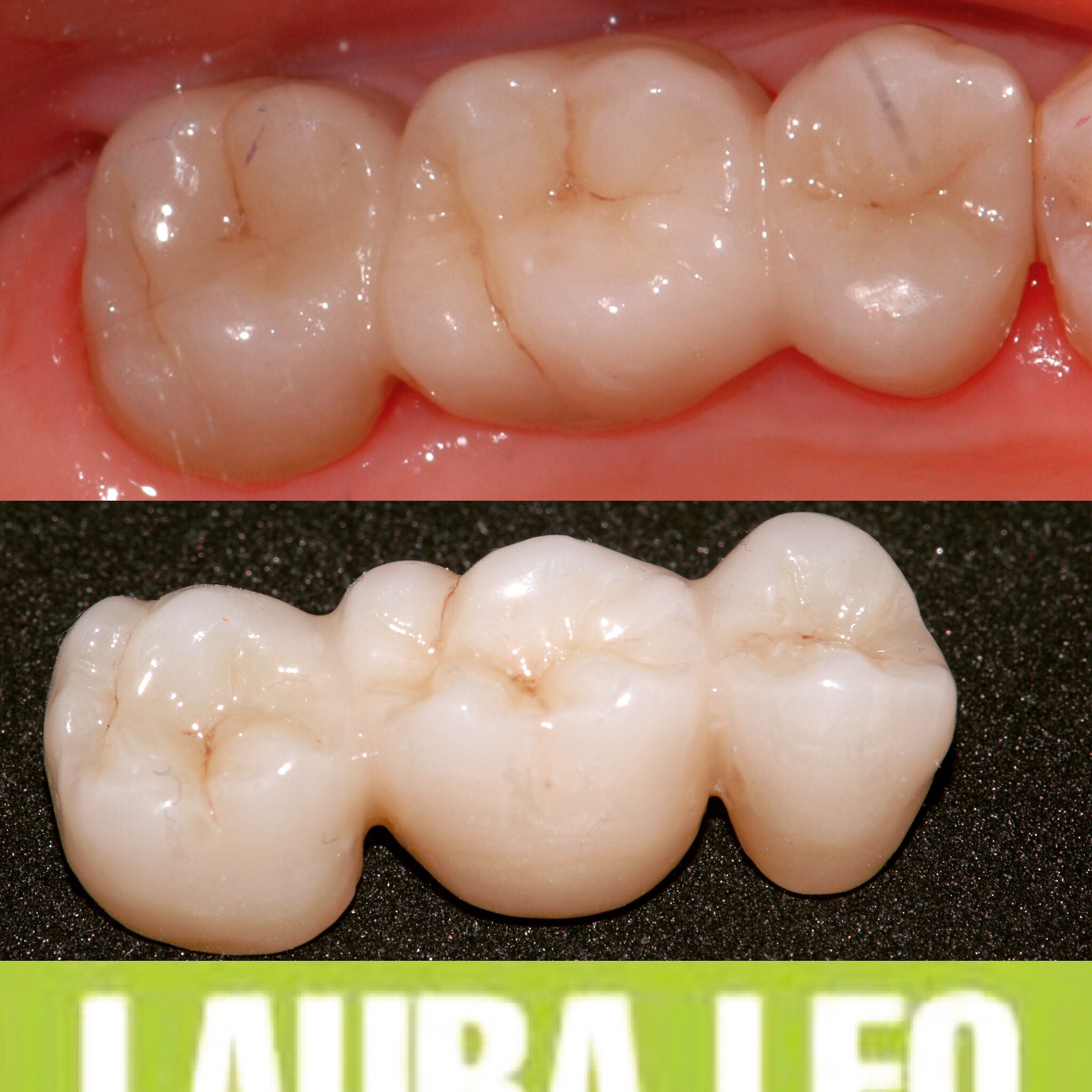Studio Dentistico Laura Leo - Terapie - PROTESI FISSA